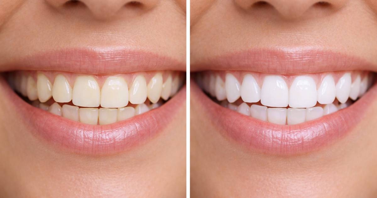 Идеальная улыбка за 7 дней: набор для отбеливания зубов за 10€ стирает пятна как по волшебству