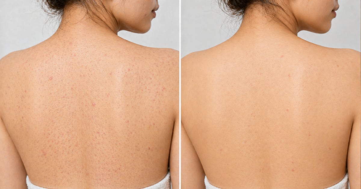 Акне на теле: маленькие прыщики исчезли — корейский уход Medicube против акне — бестселлер, который раскупают все