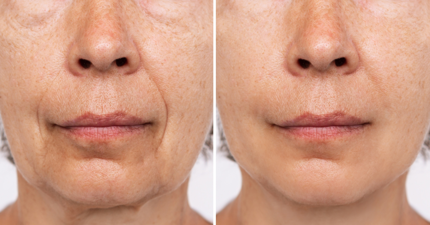 Я больше не вижу своих морщин: аптечный филлер скрывает морщины с первого применения и корректирует их день за днем