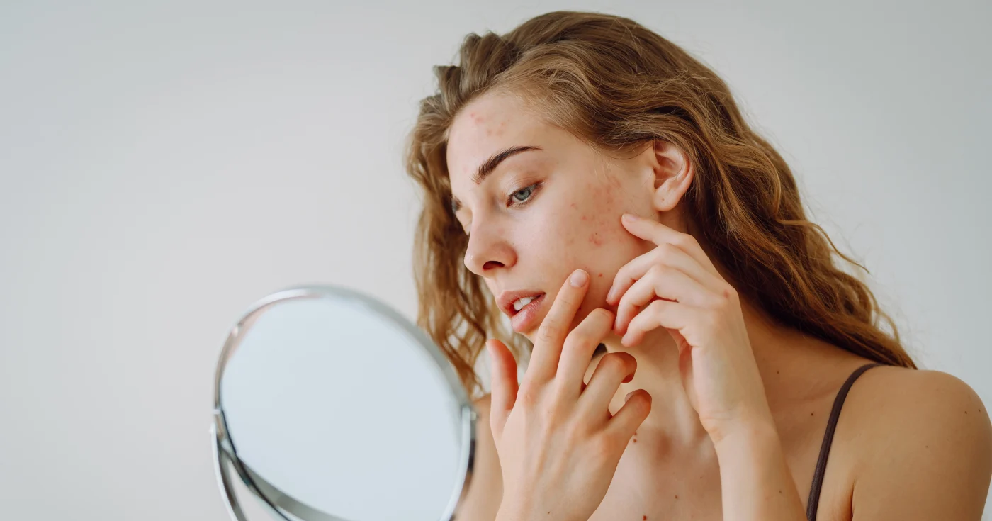 Прыщи после отпуска: специально разработанный курс против акне для кожи, склонной к высыпаниям, предотвращает повторное появление акне